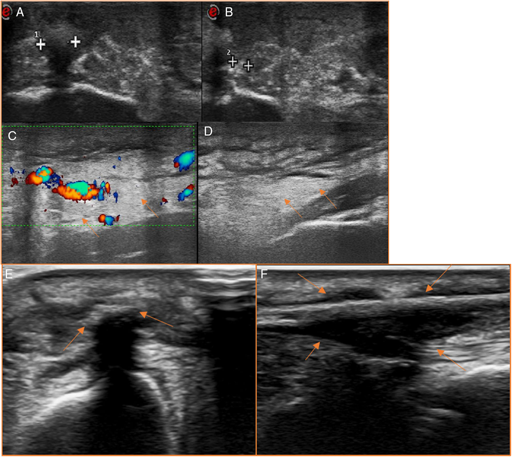 Ultrasonography of subcutaneous foreign bodies: differences depending ...