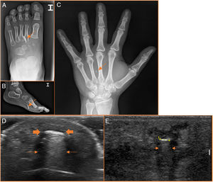 (A–C) Glass foreign bodies are radiopaque (arrows) on X-rays. (D and E) They are hyperechoic on ultrasound (thick arrows and cursors) with posterior acoustic shadowing and reverberation artefact (thin arrows).