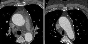 Thoracic aortic ECG-synchronised CT angiography. A) “Mushroom cap” bulge arising from the left lateral wall of the ascending aorta (arrow). B) Discrete dilation of the ascending aorta, with fluid infiltrating the mediastinal fat (arrowheads in A and B).