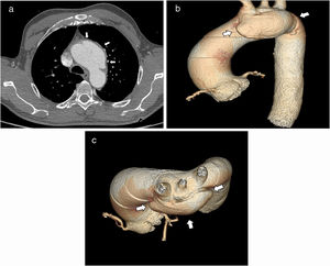 Thoracic aortic CT angiography without ECG synchronisation. A) Large saccular bulge arising from the left anterolateral wall of the aortic arch, with a “mushroom cap” appearance (arrows), and fluid infiltration of mediastinal fat. 3D volume rendering, oblique lateral (B) and cranial (C) view. The “mushroom cap” morphology of class 3 dissection (arrows) can be seen more clearly.
