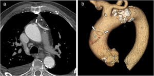 Thoracic aortic CT angiography without ECG synchronisation. A) Small bulge arising from the left anterolateral wall of the ascending aortic arch-aorta with “mushroom cap” appearance (arrow). Note the aortocoronary bypass graft (arrowheads). B) 3D volume rendering, oblique lateral view. The bulge typical of class 3 dissection (arrows) is clearly seen.