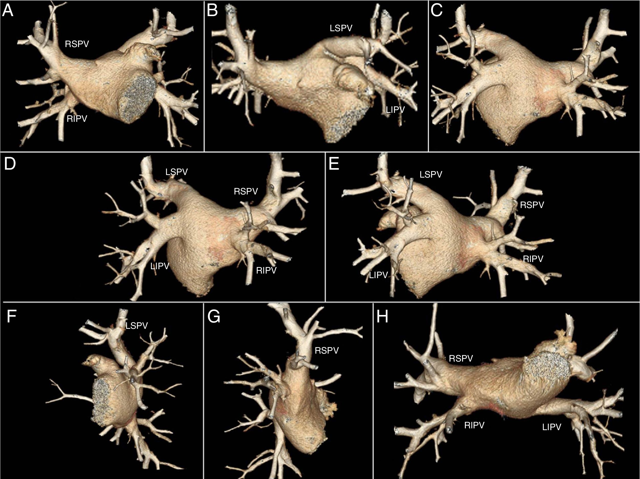 Multidetector computed tomography in planning the treatment of atrial ...