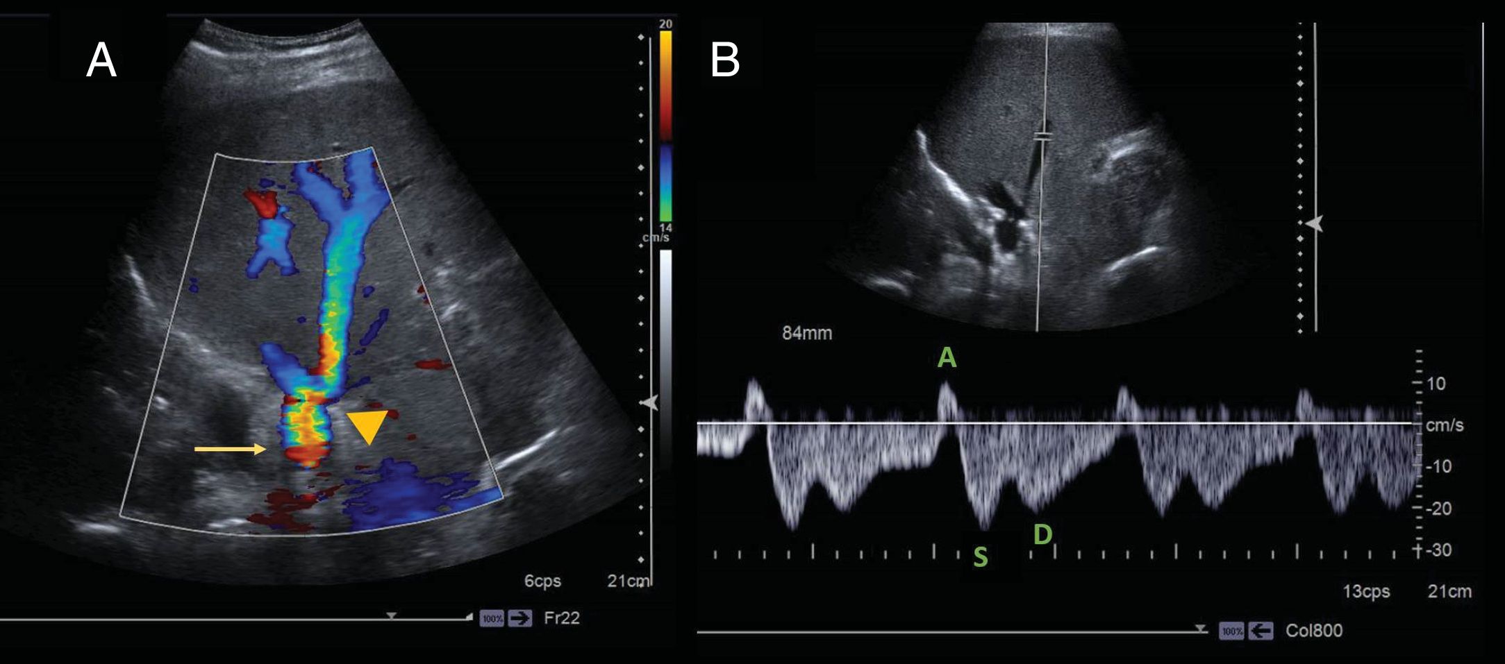Cryptogenetic Normal and transitory ultrasonography findings in the immediate ...