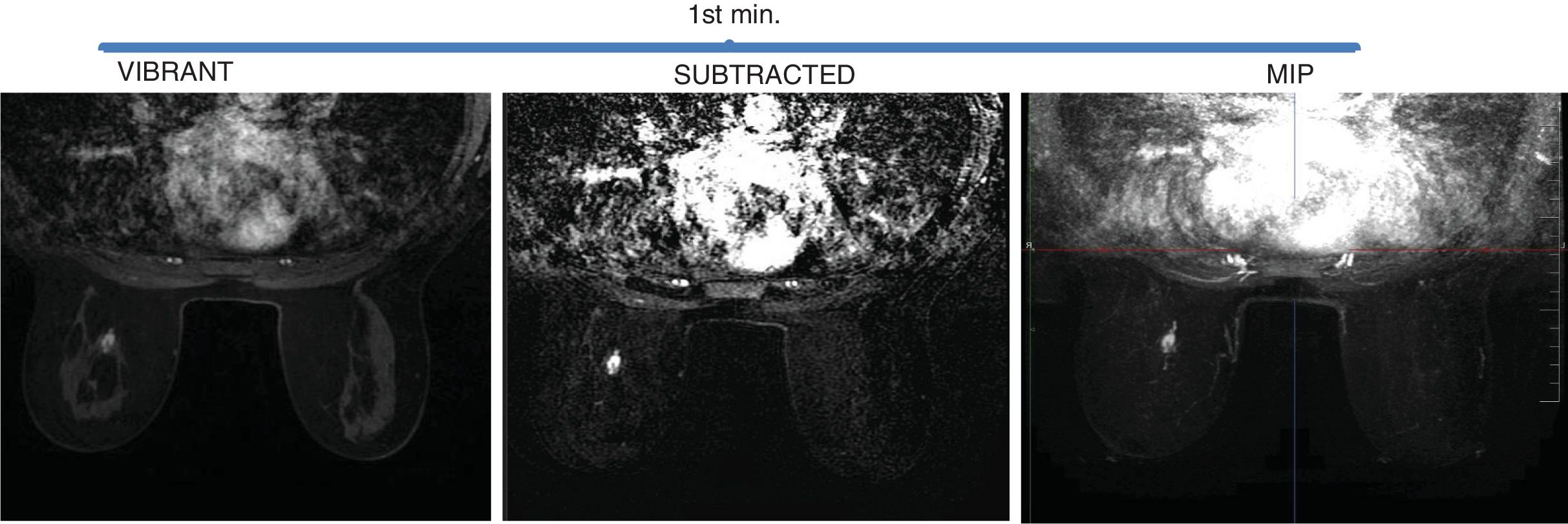 Value of an abbreviated protocol of breast magnetic resonance imaging ...