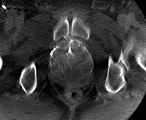 (A) Cone beam computed tomography image (axial section) to demonstrate the correct catheterisation of the prostate artery prior to embolisation: through a microcatheter and with 5 seconds of delay in Dyna-CT form, diluted contrast is introduced, marking the area of the half of the gland vascularised by said vessel.