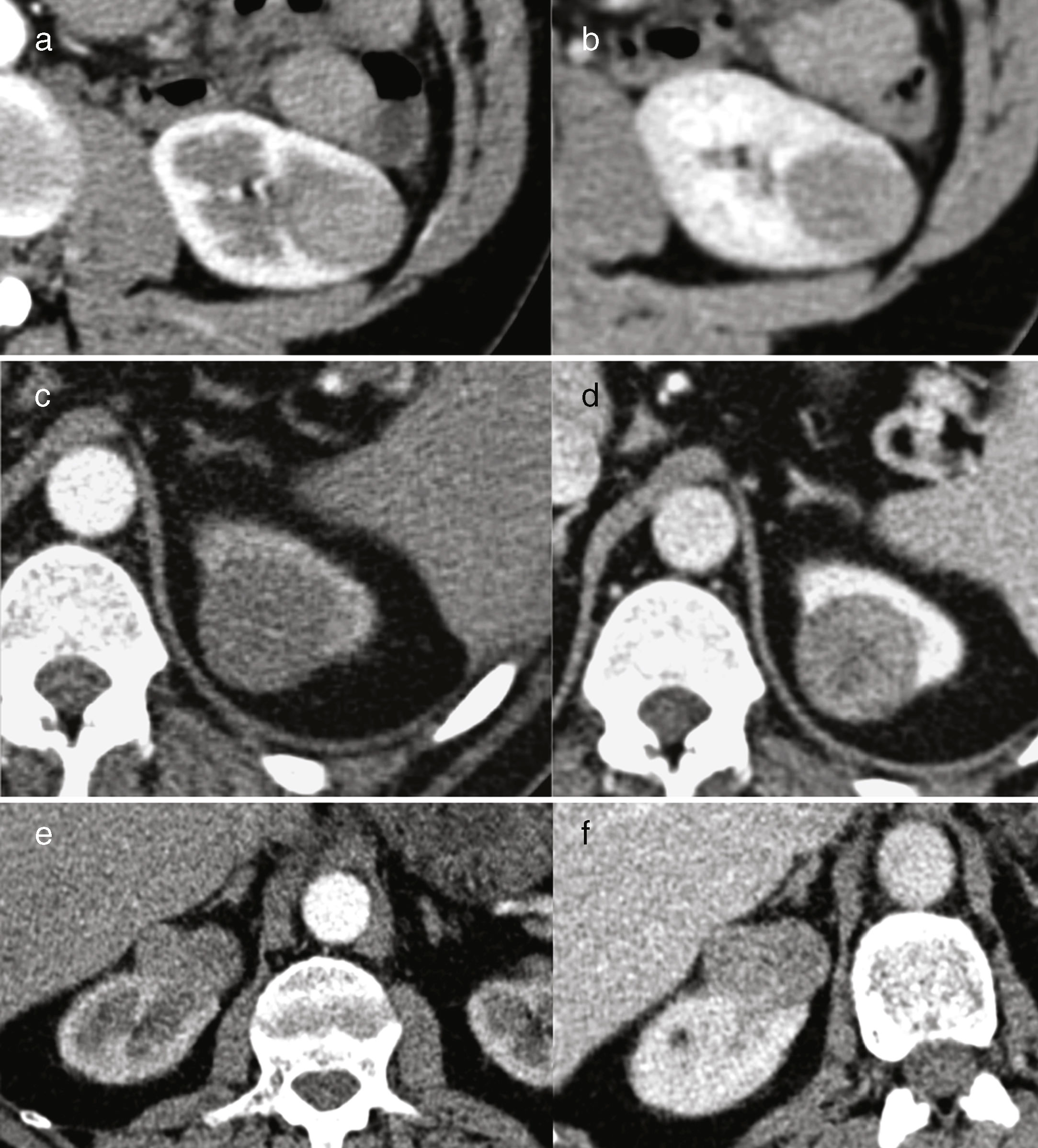 Current management of small renal masses | Radiología (English Edition)