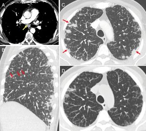A 54-year-old male with advanced renal cell carcinoma treated with nivolumab and ipilimumab combined therapy, whose images show a sarcoidosis-like pattern. (A) Chest computed tomography (CT) with mediastinal window shows mediastinal lymphadenopathy (an enlarged subcarinal node indicated with arrow). (B and C) The CT scan shows nodular images of a perilymphatic distribution pattern (arrows in the sagittal reconstruction) and pleural-based peripheral consolidation (arrows in the axial reconstruction). (D) Axial CT scan in the same patient after 2 weeks of corticosteroid treatment which shows radiological improvement.