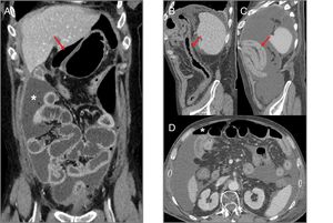 Intestinal perforation associated with VEGF-targeted therapy. Case 1 (A): 46-year-old woman with ovarian cancer being treated with bevacizumab. Computed tomography (CT) shows pneumoperitoneum (arrow) and free fluid (star) in the context of an intestinal obstruction. This obstruction was not very serious; the intestinal wall was probably weakened due to bevacizumab. Case 2 (B–D): 71-year-old male on second-line treatment with a paclitaxel-ramucirumab regimen for metastatic recurrence of gastric adenocarcinoma. (B) CT obtained during admission due to pyrexia and abdominal pain after the 2nd cycle: new-onset ascites and thickening of the transverse, descending and sigmoid colon in relation to colitis (arrow). Corticosteroid treatment and a watch-and-wait approach adopted as the patient showed clinical improvement. (C and D) CT of abdomen and pelvis performed one week later due to clinical worsening: persistence of the colitis (arrow) observed, as well as new-onset pneumoperitoneum (star) due to intestinal perforation.