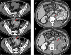 Haemorrhage associated with VEGF-targeted therapy. Case 1 (A–C): intestinal bleeding in a patient with metastatic renal cell carcinoma treated with sorafenib. Computed tomography (CT) shows a hyperdense area in an ileal loop in the arterial phase (B) which increases in the venous phase (C), suggestive of active bleeding (arrows). (A) Phase without intravenous contrast. Case 2 (D and E): patient with advanced renal cell carcinoma on treatment with sunitinib in whom retroperitoneal haemorrhage is detected. (D) Left para-aortic lymph node metastasis (star) can be identified. (E) A later CT scan shows retroperitoneal bleeding (arrow) originating from the metastatic lymphadenopathy.