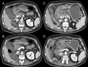 Pancreatitis in a 50-year-old man with stage IV renal cell carcinoma, treated with sunitinib. (A and B) Computed tomography (CT) shows densification of fat and peripancreatic fluid, as well as a small collection (arrow). No association between the pancreatitis and the drug is suspected and the patient continues on the same treatment. (C and D) CT scan of the same patient one month later, with multiple collections with air bubbles inside (arrow). On this occasion, sunitinib-induced necrotic pancreatitis is diagnosed and second-line treatment with axitinib is started.