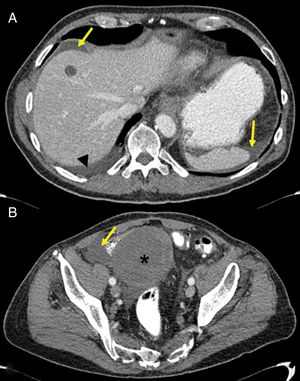 (A and B) Fluid retention in a patient treated with imatinib for a resected gastrointestinal stromal tumour with persistent pelvic metastases (star in B). The patient