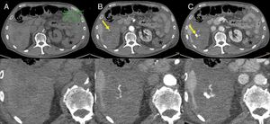 Intratumoral haemorrhage in a patient with a gastrointestinal stromal tumour treated with imatinib. Abdominal CT angiography showing extravasation of intravenous contrast in the arterial phase (B) which increases in the venous phase (C), probably secondary to active intralesional arterial haemorrhage in the perihepatic implant (arrows). Haemoperitoneum (stars) can also be seen. (A) Phase without contrast (shows a region of interest in the left flank with an average density of 30 UH).