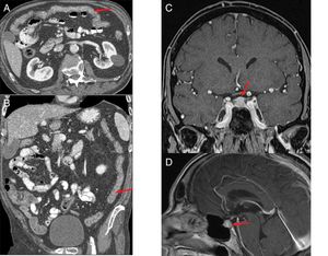 (A and B) Patient with stage IV squamous cell carcinoma of the lung, on third-line treatment with nivolumab, presenting with diarrhoea and a febrile episode. Computed tomography (CT) shows a slight diffuse wall thickening with increased enhancement of the mucosa of the colon (arrows), which extends from the transverse colon to the rectum, suggestive of colitis. (C and D) Patient with stage IV renal carcinoma due to pulmonary involvement, being treated in a clinical trial with combined nivolumab and ipilimumab therapy. The patient had a history of very intense headache for several days, without pyrexia and with normal brain CT. The magnetic resonance imaging (MRI) volumetric interpolated breath-hold examination (VIBE) (C) and T1 sequences with contrast (D) show the pituitary gland to be enlarged in relation to the age of the patient (craniocaudal diameter 9mm), with a convex-shaped superior margin and homogeneous enhancement which, in the clinical context of the patient is suggestive of immune checkpoint inhibitor-induced hypophysitis.