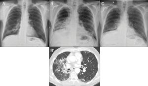 66-year-old man treated with nivolumab. (A) Chest X-ray pre-treatment with immunotherapy shows radiotherapy-related changes in the right lower lobe (RLL). (B) After 10 months of treatment, chest X-ray shows increases in density in both lower lung fields not seen on the previous X-ray. Computed tomography (B′) identifies ground glass areas associated with lung consolidation in the middle lobe, RLL and left lower lobe, compatible with nivolumab-induced pneumonitis. Corticosteroid treatment was given. (C) Chest X-ray performed one month later, in which radiological improvement can be seen.