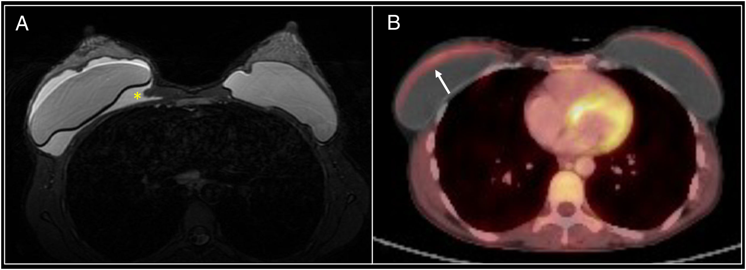 Uncommon complications of breast prostheses | Radiología (English Edition)