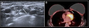 Lymphadenopathy in the internal mammary lymph node chain. A patient with a history of left mastectomy due to breast cancer and right prophylactic mastectomy with reconstruction with bilateral prostheses. The follow-up PET/CT scan identified the appearance of lymphadenopathy in the left internal mammary lymph node chain with uptake arousing suspicion of relapse (arrow). Fine needle aspiration biopsy was performed but did not identify any signs of relapse.