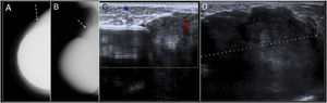 Breast fibromatosis. (A and B) Craniocaudal and mediolateral oblique mammography of the right breast. Mass with well-defined borders in the outer quadrants of the breast (arrow). The mass was found to be in close contact with the outer and posterior aspect of the prosthesis with effacement of the contour of the prosthesis and anterior displacement thereof. (C and D) On ultrasound it corresponded to a large heterogeneous mass with relatively well-defined borders in close contact with the prosthesis.