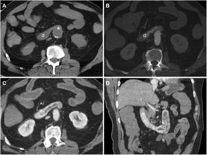 Axial slices from the same patient in Video 2. Computed tomography at baseline (A) and in arterial (B) and portal (C) phases demonstrating loss of the fat plane separating (*) the graft and the third duodenal segment (d) with active extravasation of intravenous contrast towards the duodenal lumen evident from the arterial phase. Reconstruction on the coronal plane (D).