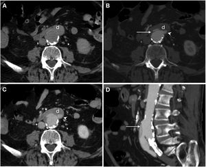Secondary aortoenteric fistula in a 77-year-old male with a history of aortobifemoral bypass surgery currently presenting an episode of gastrointestinal bleeding with massive haematochezia, abdominal distension and weak distal pulses. Baseline computed tomography (A), in arterial (B) and portal (C) phases and sagittal MIP reconstruction (D) showed an intimomedial tear (arrow) that affected the anterior surface of the graft in contact with the third segment of the duodenum (d). In addition, extravasation of aortic contrast to the gastrointestinal tract (arrow tip) was observed.