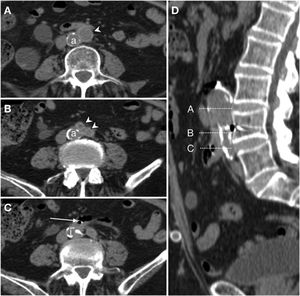 Secondary ileoenteric fistula in a 93-year-old male, with a history of aortobifemoral bypass surgery, who sought care as he presented coffee ground vomitus and melaena. Intravenous contrast was not administered due to a decreased glomerular filtration rate. Craniocaudal slices on the axial plane (A, B and C) of the aortobifemoral bypass (arrow tip) anterior to the native aorta (a) are shown. Figure C identifies intraluminal gas in the right branch of the bypass (arrow) from the immediately adjacent intestinal loop; the native iliac artery is indicated as an anatomical reference (i). Sagittal reconstruction (D) represents the level of the slices.