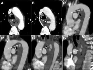 A 54-year-old male with Barrett