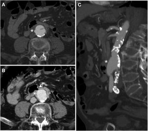 Secondary aortoenteric fistula in a 78-year-old male with a history of aortobifemoral bypass surgery and peptic ulcer disease who sought care due to signs and symptoms of upper gastrointestinal bleeding. Endoscopy revealed an ulceration of the intestinal wall with direct observation of the bypass material. In view of the patient