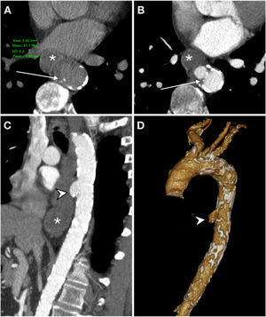 Primary aorto-oesophageal fistula in a 67-year-old male with haematemesis, profuse sweating, skin pallor and hypotension. Baseline computed tomography (A) showed oesophageal dilatation with intraluminal content of high attenuation in relation to a blood component (*) and displacement of intimal calcifications indicating rupture of an atheromatous plaque with an entrance (arrow). The arterial phase on the axial plane (B), sagittal reconstruction (C) and volumetric reconstruction (D) showed calcifications in the wall of the descending aorta and saccular dilatation (arrow tip) in contact with the oesophageal wall with no fat plane achieving separation. These findings suggested a penetrating ulcer. Despite the absence of extravasation of intravenous contrast, the presence of an aortoenteric fistula was confirmed in surgery.
