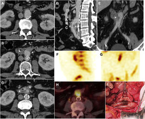 Graft erosion in a 61-year-old male with a history of aortobifemoral bypass surgery who presented long-standing fever, chills, weakness and persistent bacteraemia. Due to suspicion of graft infection, a CT scan was performed with IVC in the portal phase (A–C) which revealed perigraft oedema and parietal thickening of the third segment of the duodenum (*) encompassing the right iliac branch of the bypass in the absence of a fat plane achieving separation. Sagittal reconstruction (D) represented the level of the axial slices and coronal reconstruction (E) supported the findings reported. Extravasation of IVC was not observed. SPECT with marked leukocytes (F, G) showed radiotracer accumulation, and a PET/CT scan (H) revealed an increase in metabolic activity in the region proximal to the graft. These findings were suggestive of infection. Surgery (I) demonstrated the presence of graft erosion (dashed ellipse).