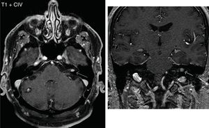 Schwannoma in the left acoustic pore in a patient who as an extraotic finding presented a cavernoma in the right cerebellar hemisphere.