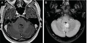 Extraotic pathology found: (A) Control magnetic resonance imaging of a patient with a right temporobasal otogenic abscess already practically in resolution. (B) Low-grade glioma in the cerebellar vermis.