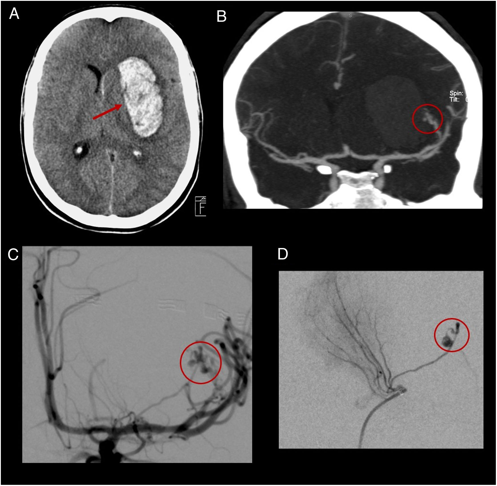 Usefulness Of CT Angiography For Characterizing Cerebral Arteriovenous Usefulness Of CT Angiography For Characterizing Cerebral Arteriovenous