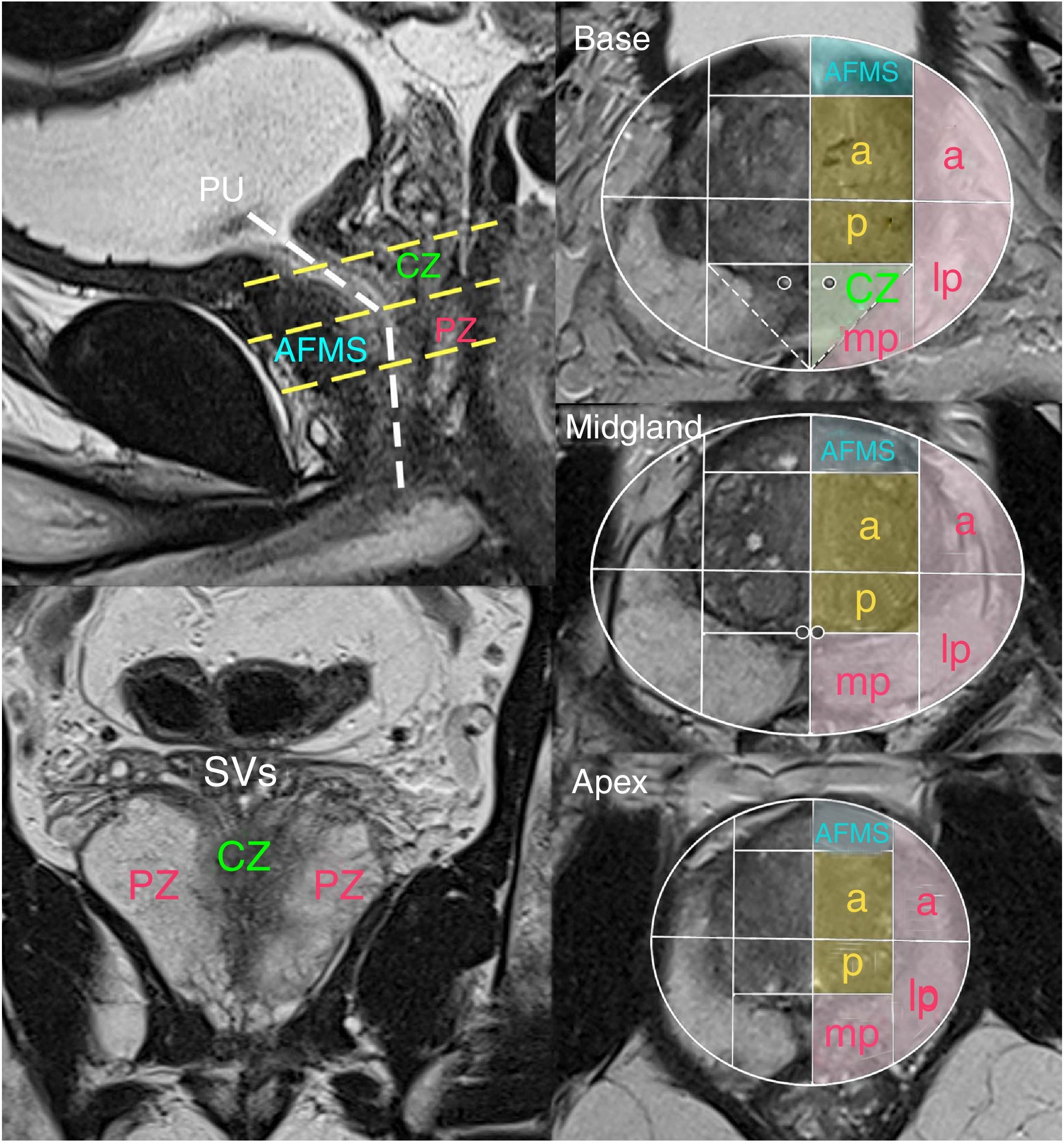 Prostate Mri Anatomy Prostate Mri Anatomy