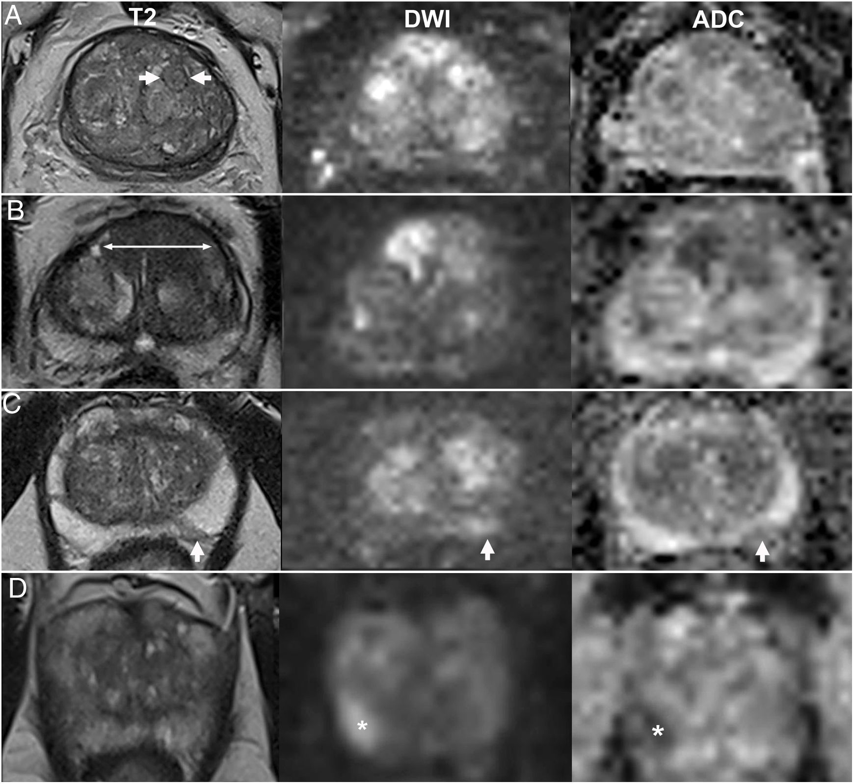 Prostate MRI: Practical guidelines for interpreting and reporting ...