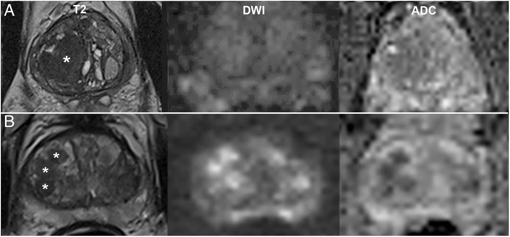 Prostate MRI: Practical guidelines for interpreting and reporting ...