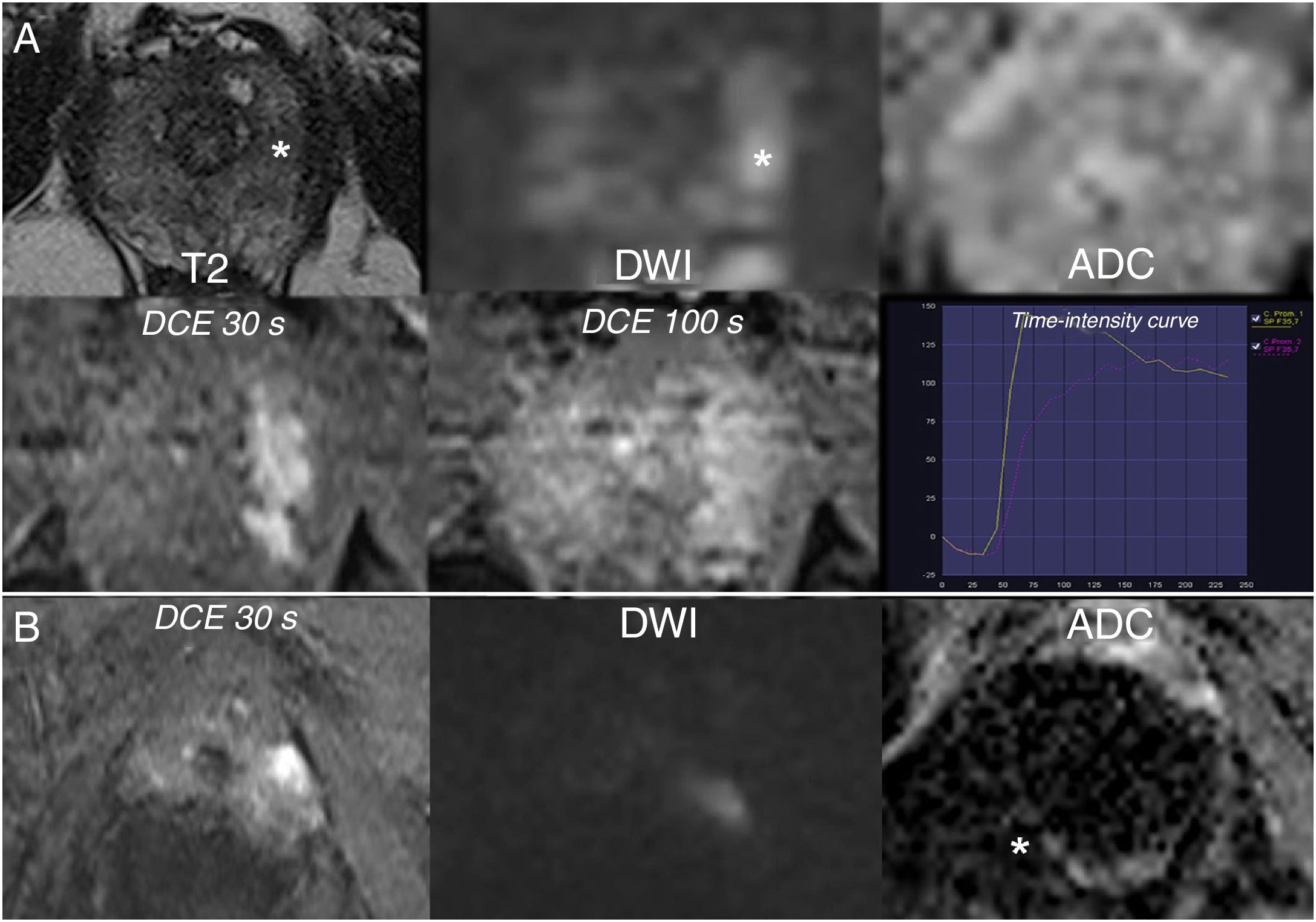 Prostate MRI: Practical guidelines for interpreting and reporting ...