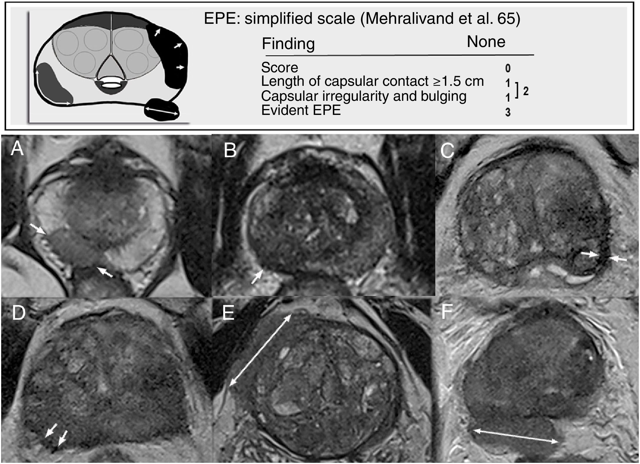 Prostate MRI: Practical guidelines for interpreting and reporting ...