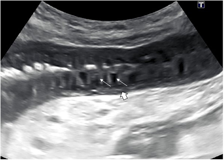 Valvulae Bowel ultrasound: Examination techniques and normal and pathologic ...