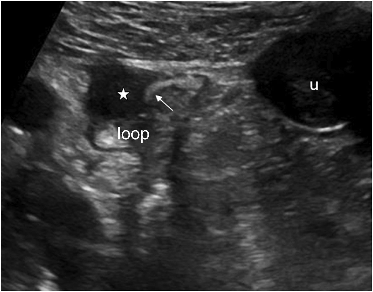 Bowel ultrasound: Examination techniques and normal and pathologic ...