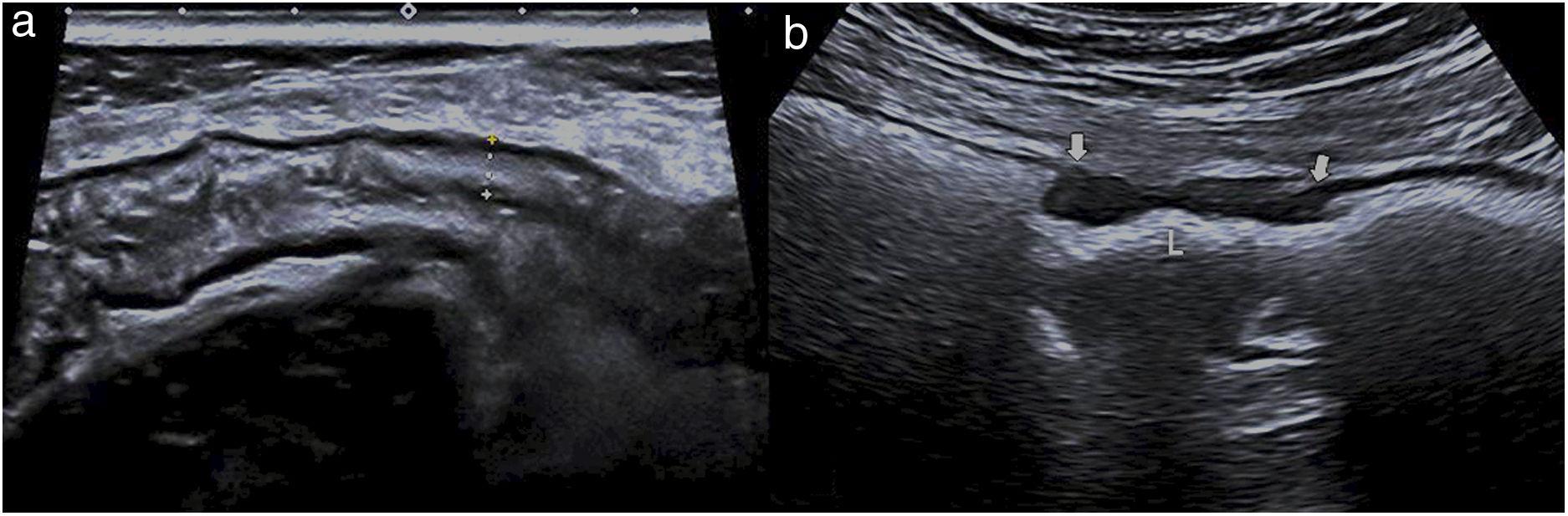 Bowel Ultrasound Examination Techniques And Normal And Pathologic bowel-ultrasound-examination-techniques-and-normal-and-pathologic