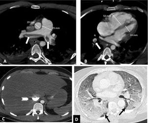 Central pulmonary thromboembolism with signs of right heart overload in a patient with severe COVID-19. Chest CT angiography. A-C) Knuckle thrombus at the bifurcation of the pulmonary arteries and in the lobar artery of the right lower lobe (white arrows). Signs of right heart overload: pulmonary artery/aorta ratio >1, enlargement of the right heart chambers with straightening of the intraventricular septum and reflux of intravenous contrast into the inferior vena cava (arrow head). D) Severe parenchymal involvement by COVID-19. Ground-glass pattern involving more than 60% of the lung parenchyma. The black arrows point to the intact lung parenchyma in both lower lobes.