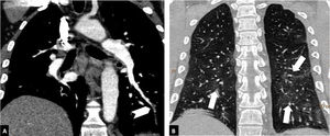 Distal pulmonary thromboembolism in a patient with mild parenchymal involvement by COVID-19. Chest CT angiography. A) Filling defect in a basal distal segmental artery of the left lower lobe (white arrow head). B) Ground-glass parenchymal involvement in both lower lobes (arrows), affecting less than 30% of the lung parenchyma.