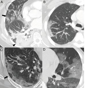 Common findings in the first two weeks of the disease. A) Mixed ground-glass (arrow) and consolidation (arrow tip) opacities, predominantly posterior, with linear margins showing a geographic pattern. Some perilobular opacities (circle) are also observed. B) Peripheral consolidation opacity with linear margins. C) Peripheral perilobular opacities (arrow). D) Cobblestone pattern, with ground-glass opacities and overlapping reticular pattern secondary to thickening of the interlobular and intralobular septa.