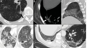 Late findings. A and B) Vascular dilation, with a focal increase in the thickness of subsegmental arteries within the pulmonary opacities. C) Pleural thickening evident at the level of the right major and minor fissures. D) Resolution of the consolidation foci that progressed to ground-glass opacities in the late phase and development of pneumatoceles (arrow). E and F) Inverted halo or atoll sign, consisting of a ground-glass opacity surrounded by a complete or incomplete ring of consolidation (arrows).