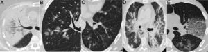 Radiological findings in cases of pneumonia with an aetiology other than COVID-19. A) Lobar consolidation in Streptococcus pneumoniae pneumonia. B) Peribronchovascular “clustered” opacities caused by respiratory syncytial virus. C) Branched opacities with a tree-in-bud morphology in influenza A virus infection D) Peribronchovascular consolidation in bilateral influenza A virus pneumonia E) Cobblestone pattern in Streptococcus pneumoniae pneumonia.