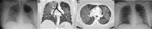A 34-year-old woman, a multi-drug addict, who presented during the pandemic with fever, dyspnoea and hypoxaemia, as well as elevation of D-dimer. A portable chest X-ray (A) showed extensive bilateral consolidation. Pulmonary CT angiography was performed (coronal reconstruction in B; axial image in C) that showed a diffuse cobblestone pattern, with a central predominance and no pleural effusion. As non-cardiogenic pulmonary oedema due to drugs was suspected, the patient was treated with corticosteroids, with rapid complete resolution of clinical and radiological signs and symptoms at 24 hours (D), which is characteristic of the disease. The patient had presented a similar clinical picture one month earlier with an identical outcome.