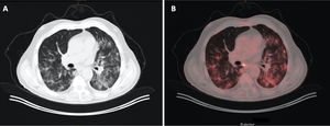 A 71-year-old man with a history of colon carcinoma, in whom monitoring revealed an indeterminate pulmonary nodule. A) Image from CT with lung window. B) Image from a PET/CT scan showing increased areas of bilateral density characteristic of COVID-19, which exhibit metabolic uptake.
