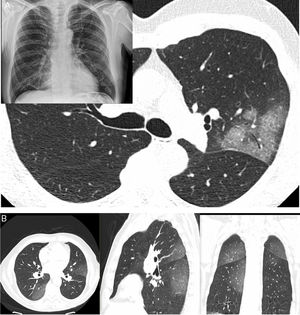 A) A 61-year-old man (healthcare worker). He had fever, asthenia, muscle pain and cough for 4 days (positive PCR). In addition, a chest X-ray with blurring of the right cardiac silhouette (the patient had pectus excavatum) showed a subtle increase in density in the left upper lobe (LUL); as a result, a CT scan was ordered. The CT scan revealed a lesion with a crazy-paving pattern and air bronchogram in the LUL; no other lesions were seen anywhere else in the lung. B) A 66-year-old man had signs and symptoms suggestive of COVID-19 for 6 days. He had significant fever and cough with no notable expectoration. Ageusia and anosmia. No dyspnoea. Negative PCR. A CT scan showed increases in peripheral bilateral density with a posterior predominance, exhibiting a ground-glass pattern.