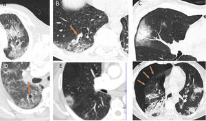 Other radiological patterns on CT in patients with COVID-19: A) Crazy-paving pattern. B) Vascular thickening inside lesions. C) Halo sign. D) Vacuolisation. E) Reversed halo sign. F) Spontaneous pneumothorax.
