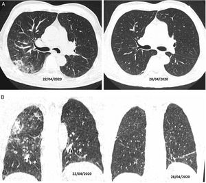 CT on axial (A) and coronal (B) planes. A 56-year-old man, diabetic, with signs and symptoms of malaise and 39 °C fever, without cough, for 10 days. He was treated with hydroxychloroquine, ceftriaxone and azithromycin. On his sixth day of admission, as he was not following a favourable clinical course, a decision was made to treat him with corticosteroids (22/04/2020); after four days of this treatment, he showed clinical and radiological improvement (28/04/2020).