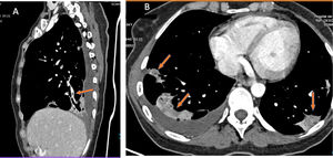 A patient with COVID-19 and pulmonary thromboembolism. D-dimer 12,556 ng/mL. CT with intravenous contrast. A) This shows filling defects in distal (segmental) pulmonary arteries. B) Strikingly, the axial image shows zones of lower density in the areas of lung consolidation, suggesting zones of infarction. This sign, when detected, should alert the clinician to the possibility of pulmonary thromboembolism and prompt reassessment of distal and small vessels for its presence.